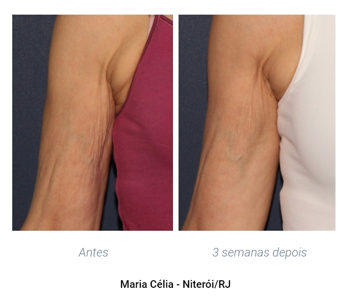 Resultados antes e depois