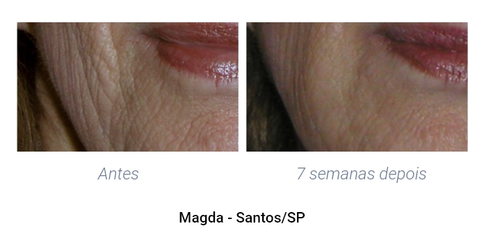 Resultados antes e depois